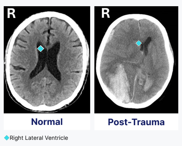 CT comparison illustrating normal and post-trauma ventricular anatomy