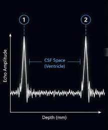 Illustrative double-wall A-mode signal